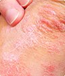 eczema dry skin