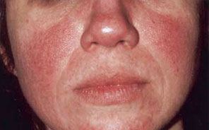 rosacea